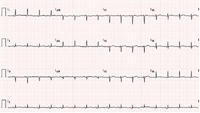 Efficacy and safety of anakinra in radiation-induced acute pericarditis: a case report